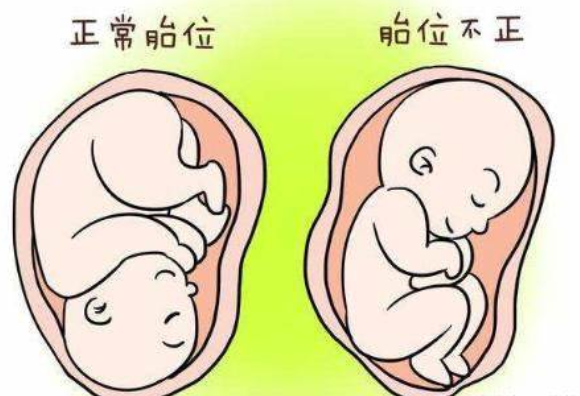 不同类型的胎盘异常采取不同干预措施